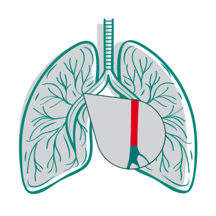 type-lung-img